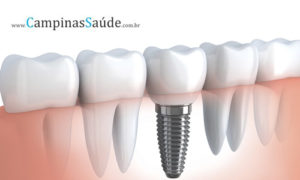 QUAL O CUSTO DE UM IMPLANTE DENTÁRIO ?