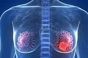 Mitos e verdades relacionado ao câncer de mama Mitos e verdades relacionado ao câncer de mama