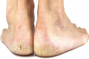 Como tratar rachaduras nos pés?