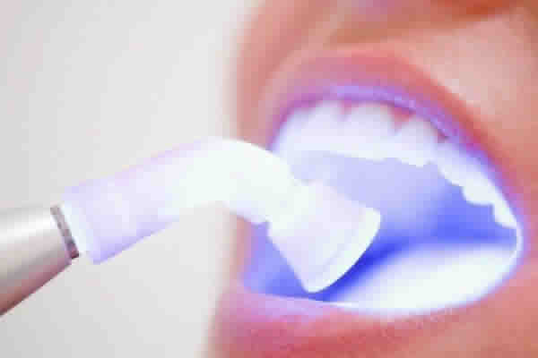 Clareamento é um procedimento coberto pelo plano dental?