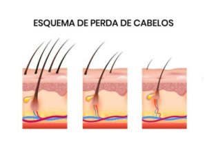 Esquema de perda de cabelos